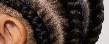 How to (Effectively) Stop Dandruff When You Have Textured Hair